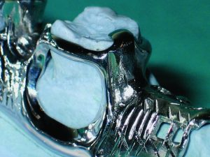 Figure 5-21. Minor connectors that join the clasps to the major connector and are positioned adjacent to the edentulous space should not be excessively bulky.