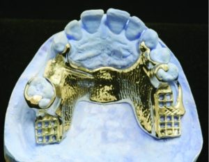 Figure 6-1. On the distal extension side of the prosthesis, the denture base will be fabricated from acrylic resin over a lattice-type minor connector, whereas on the tooth-supported side, the base will be completed as a combination of metal and acrylic resin. The shapes of the minor connectors differ between the two denture bases.