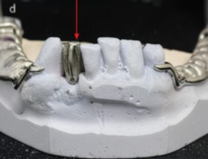 Şekil 6-5d. Faset diş: Metal alt yapıda üst santralin palatinal (d) görünümleri.