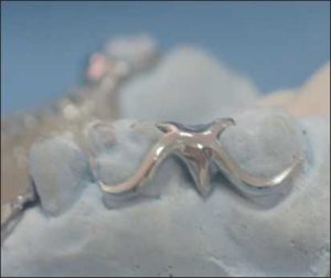 Figure 6-9. Metal teeth may be preferred for the restoration of limited spaces.