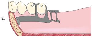 Figure 7-15. a) When the lingual alveolar ridge is inclined inferiorly and posteriorly, relief beneath the lingual bar may not be necessary.