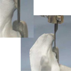 Figure 7-5. Prominent mylohyoid ridge region.