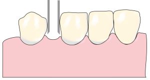 Figure 7-9. Dental surveying can be used to evaluate anterior edentulous spaces from an esthetic perspective and to eliminate problems.