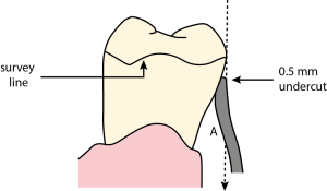 Figure 8-18. When a smaller undercut on the tooth surface is used, a wide space (A) remains between the tooth and the retentive clasp.