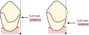 Figure 8-19. The level of the equator line can be lowered by modifying the tooth surface.