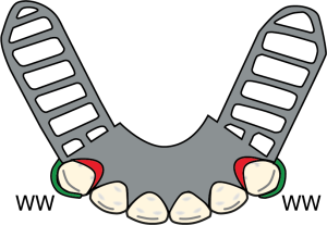 Figure 8-24. Use of wrought wire clasps on anterior teeth in Cl I prostheses when a mesiobuccal undercut is present provides an esthetic advantage (WWC: Wrought Wire Clasp).