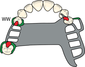Figure 8-27. In Cl II prostheses, the use of a flexible clasp design on the abutment tooth anterior to the modification space is recommended (WW: Wrought wire clasp).