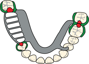 Figure 8-29a. Cl III denture clasp designs for the maxilla.