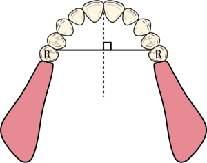Figure 8-32. Indirect retainer positioning in a Class I design. (R): Retainer.