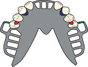 Figure 8-34. In Class I prostheses, when an anterior modification is present, a cingulum rest cannot be used as an indirect retainer on anterior teeth due to the inclined plane principle. A U-shaped plate providing rugae support, combined with cingulum rests on the canines, serves as the most ideal indirect retainer.