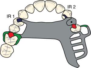 Figure 8-35. The auxiliary occlusal rest (IR 1) used on the first premolars, where the fulcrum axis intersects the opposing arch, functions as an indirect retainer. The canine extension (IR 2) on the edentulous side also serves as an indirect retainer, although it is less effective than the one on the opposing arch.
