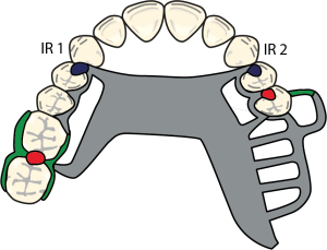 Figure 8-36. The auxiliary occlusal rest (IR 1) on the premolar opposite the free-end area provides more effective indirect retention because it is located farther from the fulcrum axis than the rest (IR 2) placed on the free-end side.