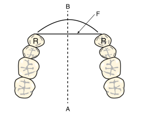 Figure 8-38. Indirect retainer positions (A and B) in Cl IV design (R: Retainer, F: Fulcrum axis).