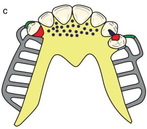 Figure 8-40. Major connector options when tissue support is not required. a) Palatal strap b) Anteroposterior palatal bar c) U-shaped palatal plate