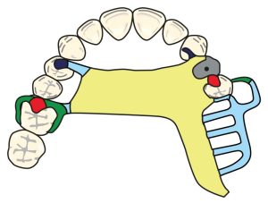 Figure 8-41. Minor connectors uniting the direct retainers, indirect retainer, and artificial teeth to the palatal strap.