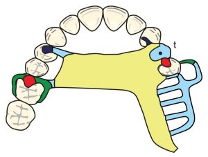 Figure 8-42. Use of tube teeth in cases of single tooth loss in the premolar region provides advantages in durability and aesthetics (t: tube tooth).