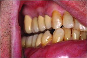 Figure 9-1. In canine-guided occlusion, the incisal edge of the lower canine slides over the palatal slope of the upper canine. Disclusion occurs on the teeth other than the canine on the working side.