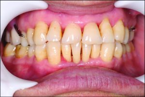 Figure 9-7. Simultaneous bilateral contacts of opposing posterior teeth in centric occlusion.