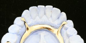 Figure 4-3. Auxiliary occlusal rests placed in the mesial fossae of the first premolars act as indirect retainers and contribute to the support and stabilization of the removable partial denture.
