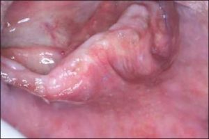 Figure 10-10. Sharp bony spines on the ridge.