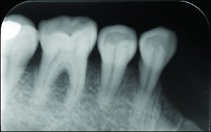 Figure 10-13. a) Periapical image of the abutment teeth.