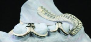 Figure 10-13. b) Multiple clasp design for splinting with removable partial denture: Since the second molars and second premolars have insufficient bone support, the buccal clasp arms are placed on the survey line and used for splinting function without providing retention.