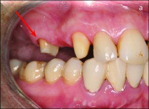 a) Splinting with fixed partial denture