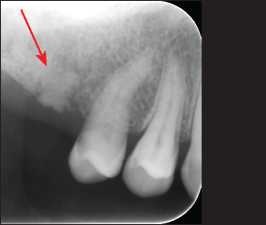 Figure 10-2. Radiographic view of a root remnant located near the surface and presenting pathological appearance.