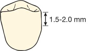 Figure 10-22. The height of the guide plane adjacent to the distal extension denture base is approximately 1.5-2 mm.