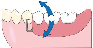 Figure 10-23. The lower height of the guide plane adjacent to the distal extension denture base reduces contact with the minor connector (approximal plate), allowing the rotation of the prosthesis. This reduces the torque force transmitted to the abutment tooth.