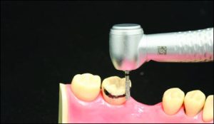Figure 10-26. Contour height before preparation.