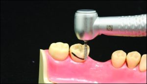 Figure 10-27. Change in contour height and survey line after preparation.