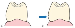 Figure 10-28. a) Abutment tooth without contour on the vestibular and lingual surfaces, b) Slight indentation created by preparation on the vestibular surface.