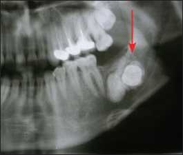 Figure 10-3. Impacted tooth located in an edentulous area exhibiting pathology, and resulting overeruption of the opposing maxillary molar.