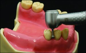 Figure 10-29. The retentive area is shaped as a slight indentation on the vestibular surface with a round diamond bur used in the anteroposterior direction.