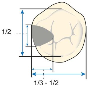 Figure 10-31. The size of the occlusal rest should be one-half of the buccolingual width and one-third to one-half of the mesiodistal width between the cusp tips of the tooth.