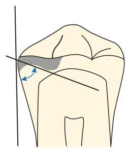 Figure 10-32. The angle between the base of the rest seat and the line drawn parallel to the long axis of the tooth from the proximal surface of the tooth must be less than 90°.