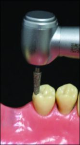 Figure 10-37. The rest seat is shaped by the round end tapered bur. The preparation is then deepened using the same bur.