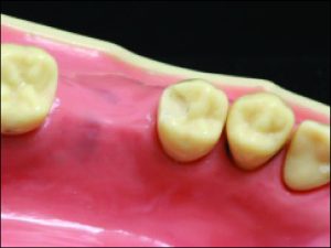 Figure 10-38. Prepared occlusal rest seat