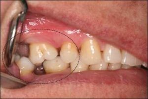 Figure 10-4. Positional changes in the opposing and adjacent teeth following the loss of a mandibular molar.