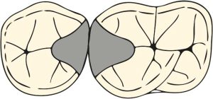 Figure 10-39. The embrasure rest seat consists of two adjacent occlusal rest seat.