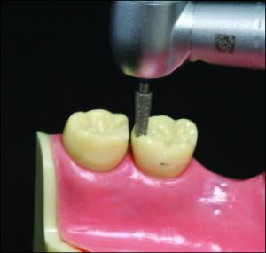 Figure 10-40. The embrasure rest seat is prepared with a round end tapered bur. Care is taken to ensure that the vestibular and lingual extensions are sufficient.