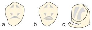 Figure 10-42. Lingual (cingulum) rest seats with different designs: a) "V"-shaped b) "U"-shaped c) Flat ledge design