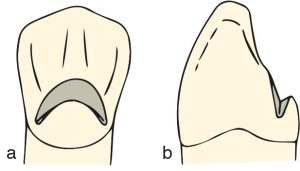 Figure 10-44. Cingulum rest seat: a) view from the lingual surface, b) view from the proximal surface.