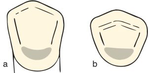 Figure 10-46. "U" or "C" cingulum rest seat: a) view from the lingual surface, b) view from the incisal surface.