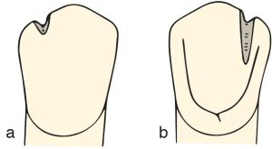 Figure 10-47. Incisal rest seat: a) view from the buccal surface b) view from the lingual surface.