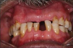 Figure 10-5. Overeruption of the lower anterior teeth along with the alveolar bone, following the loss of the upper teeth.