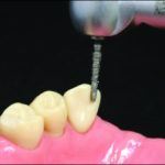 Figure 10-48. Flame-shaped or round-ended slender tapered burs can be used for preparing the incisal rest seat.