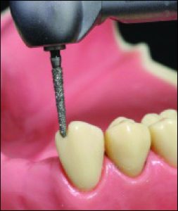 Figure 10-50. The incisal rest seat should be located 2–3 mm away from the proximal corner and have a depth of 1.5–2 mm.