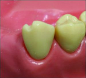Figure 10-51. Incisal rest seat: The final preparation should have smooth surfaces and should not cause discomfort to the patient.